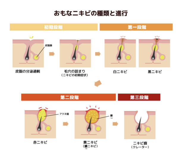 ニキビの種類