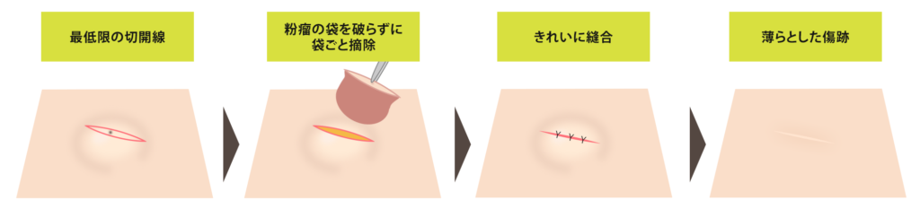 粉瘤　切除法