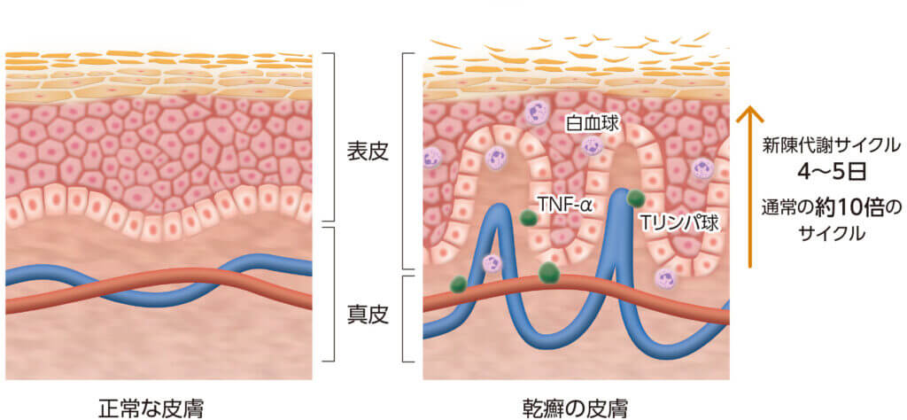 乾癬と健常者の皮膚の違い