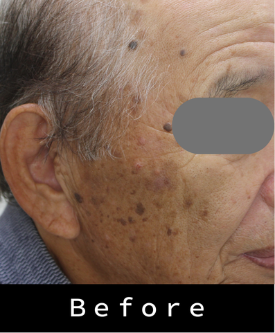 脂漏性角化症、いぼとり前の症例写真