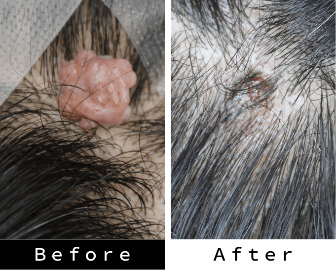 頭部のほくろの自費治療のbefore、afterです
