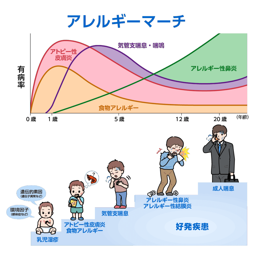 アトピーのアレルギーマーチについて