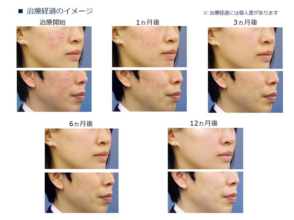 ニキビの治療経過イメージ