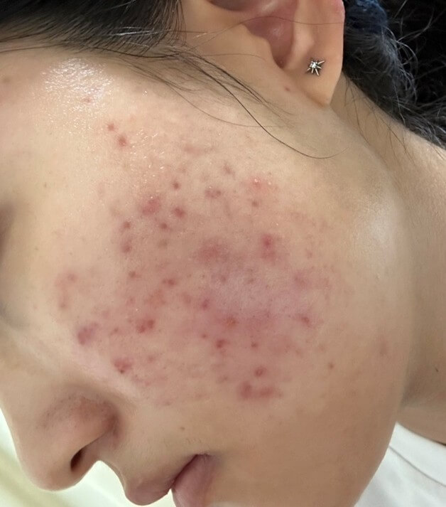 イソトレチノイン治療の適応となる重症なニキビ