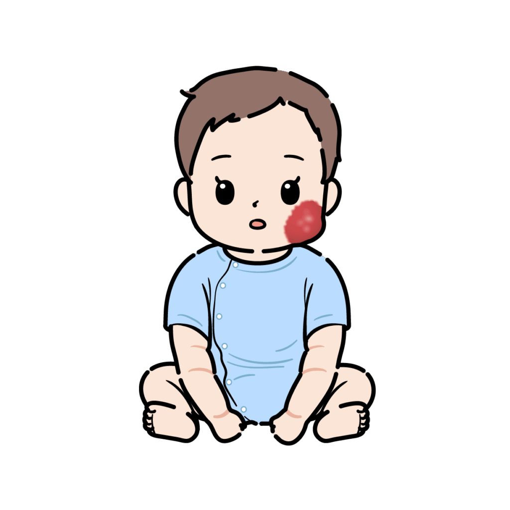 赤あざの赤ちゃん