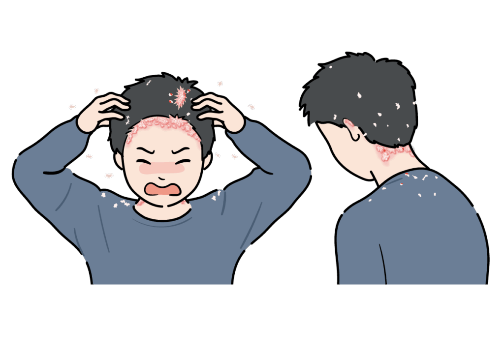 乾癬の症状