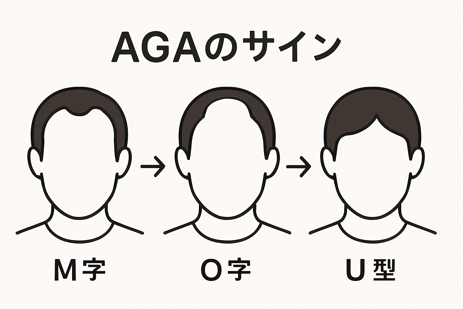 AGA、男性のうす毛。図解