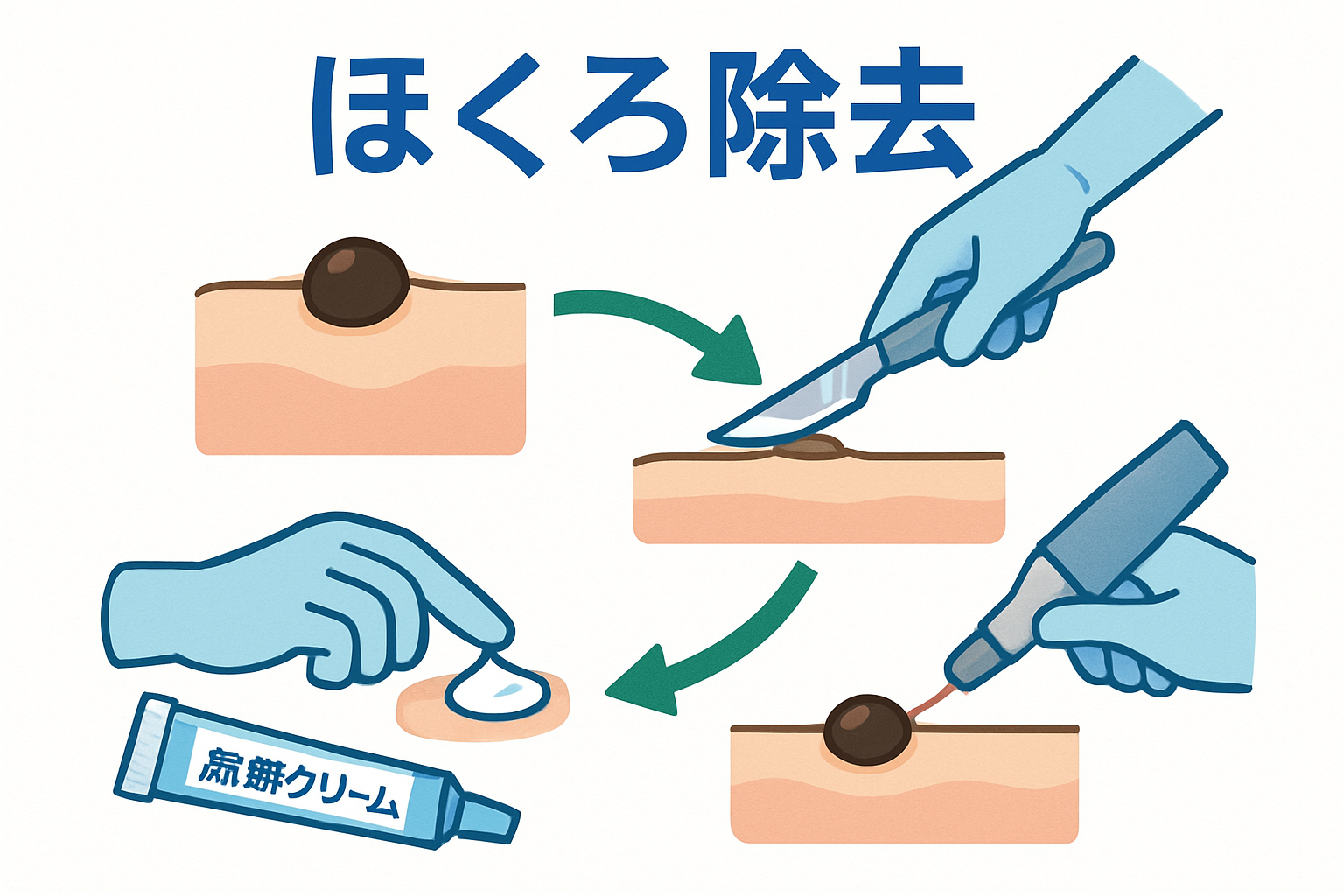 ほくろ除去
