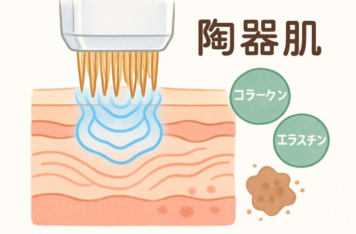 シルファームはマイクロニードルRF