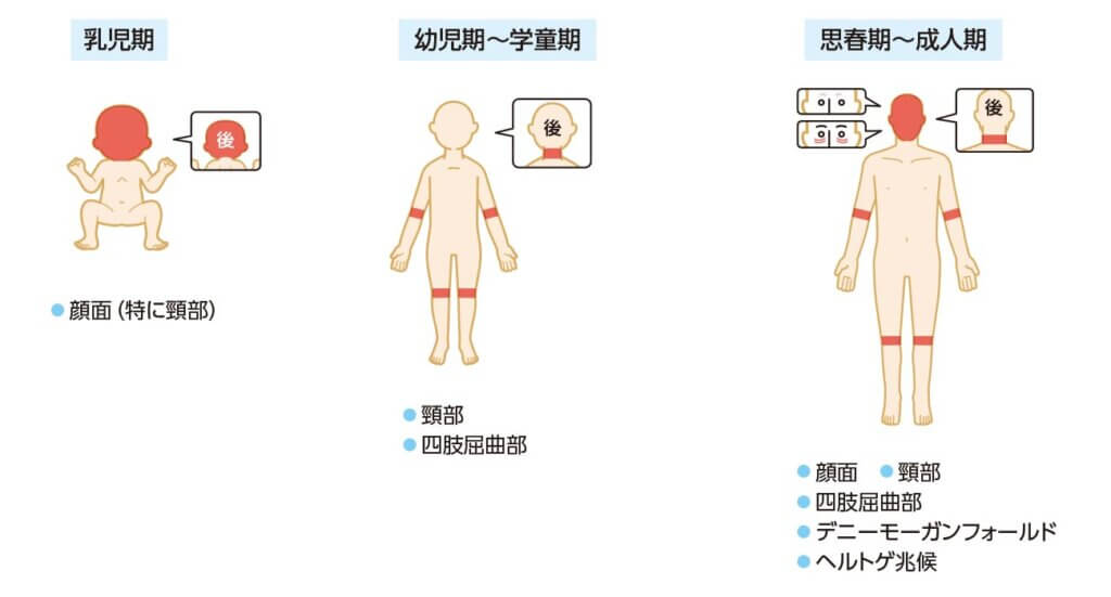 アトピー性皮膚炎の年齢別の症状分布図
