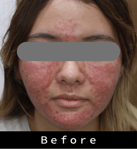 酒さ症例①　治療前