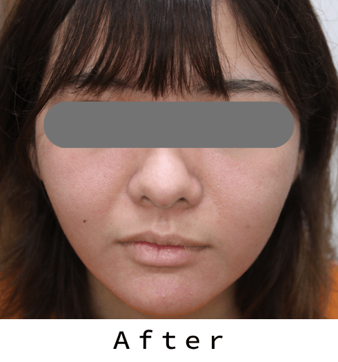 酒さ症例①　治療後