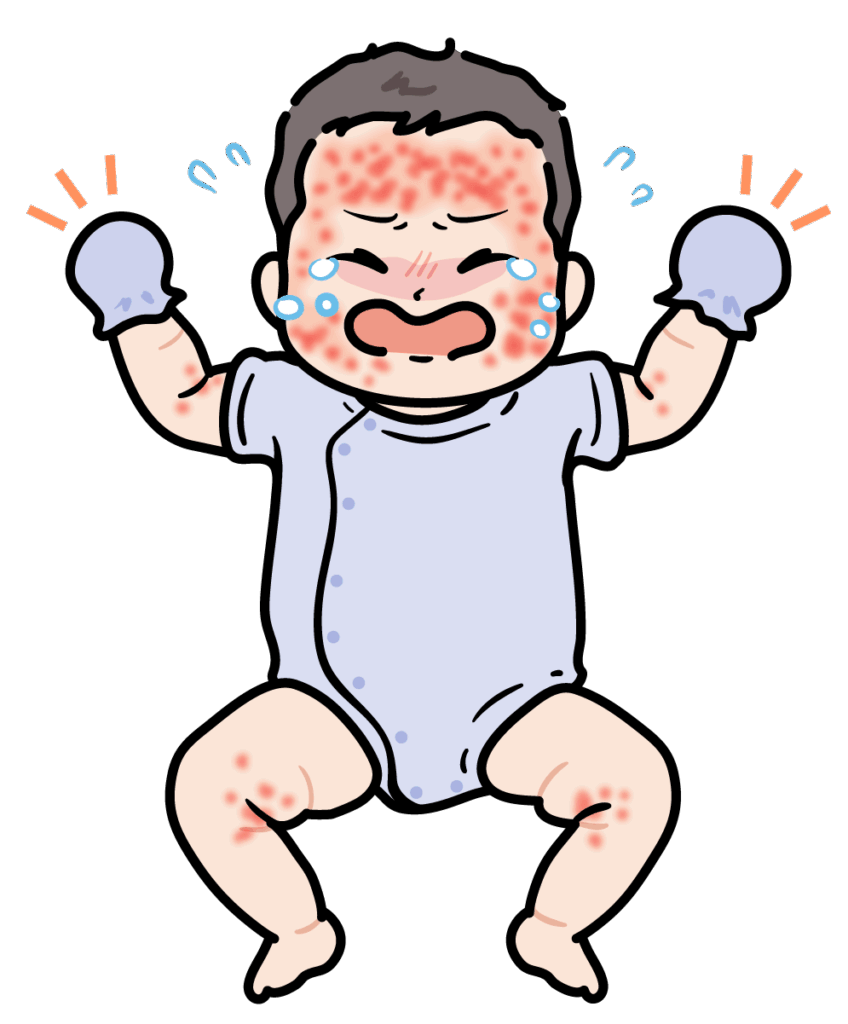 とびひで掻きむしらないようにミトンをするのも方法です