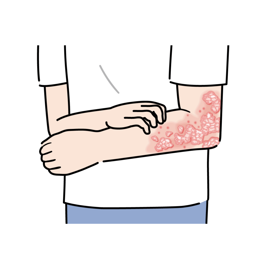 乾癬と鑑別すべき疾患