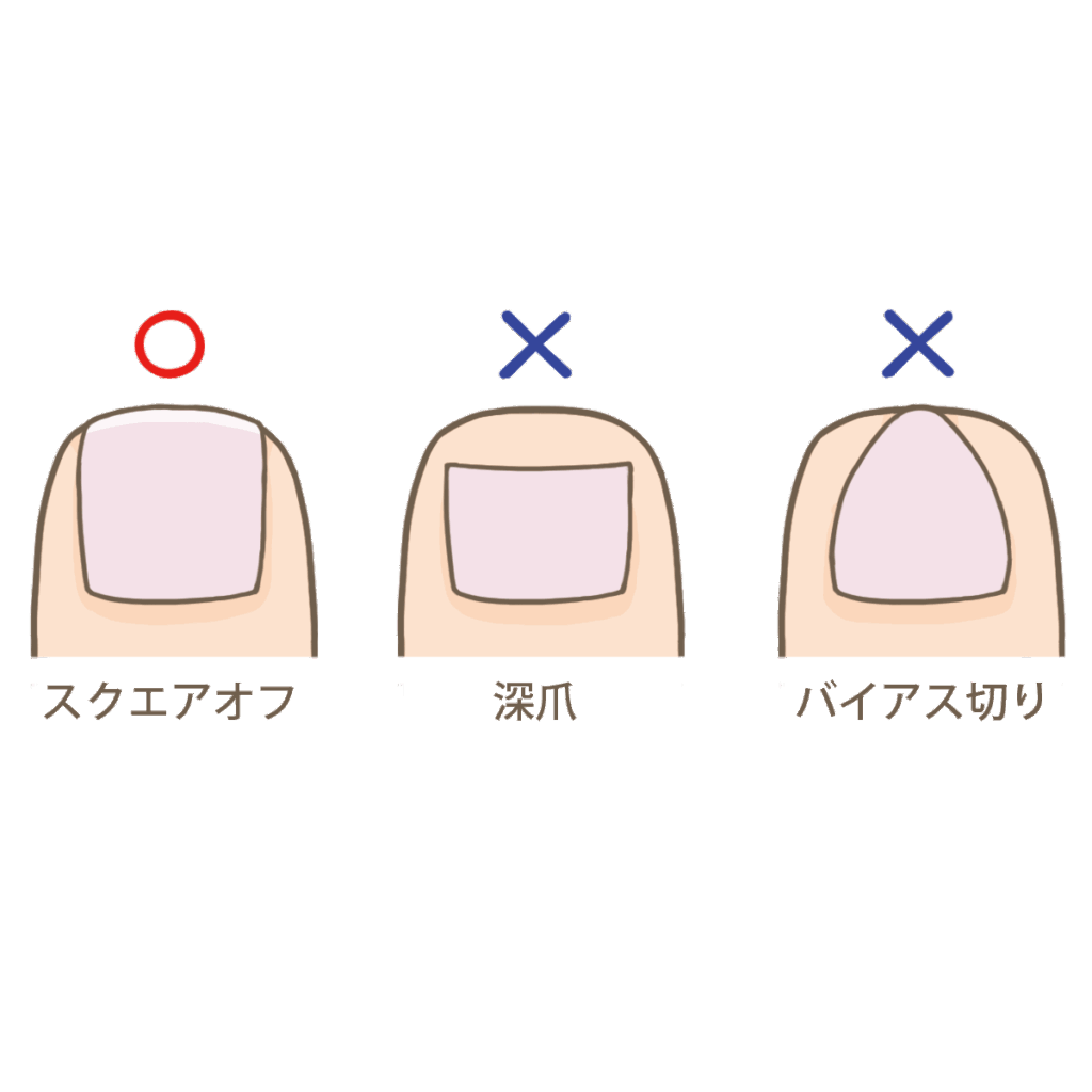 巻き爪の方の爪の切り方について