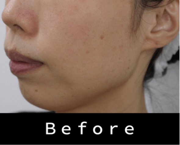 ヒアルロン酸の症例