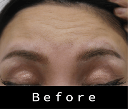 ヒアルロン酸の症例