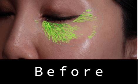 ヒアルロン酸の症例