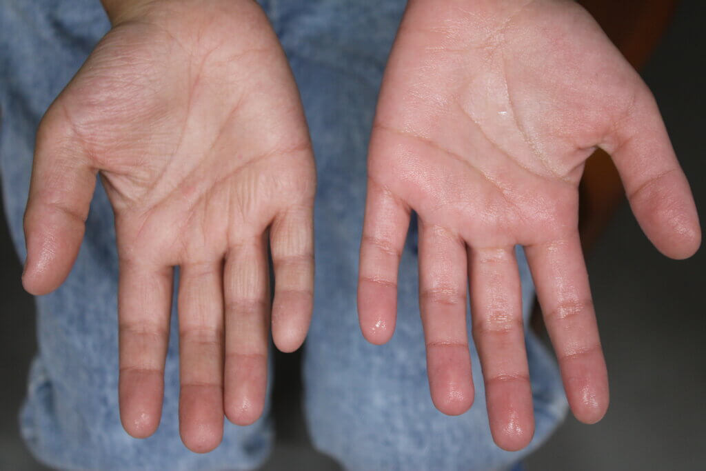 多汗症に対して塩化アルミニウム軟膏を使用した症例