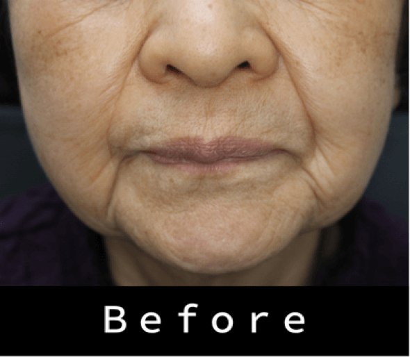 ヒアルロン酸の症例