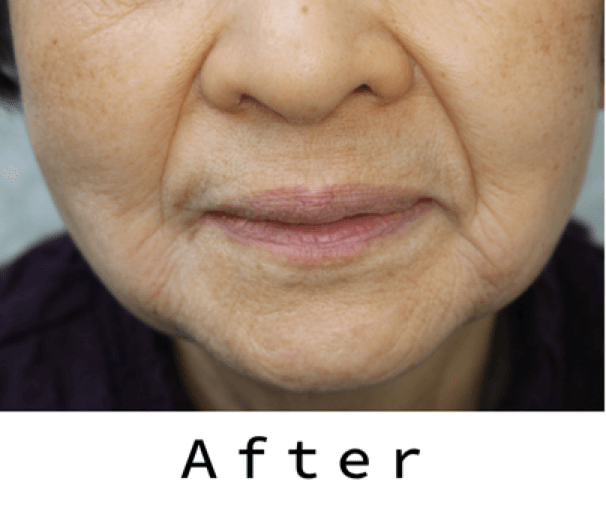 ヒアルロン酸の症例