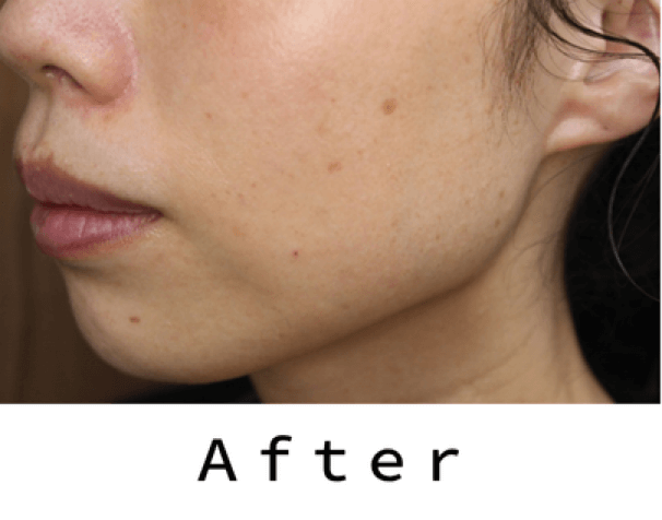 ヒアルロン酸の症例