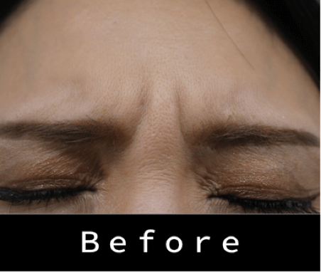 ヒアルロン酸の症例