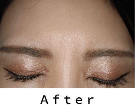 ヒアルロン酸の症例