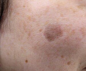 シミ取りが難しいと言われる、LPLKの写真です