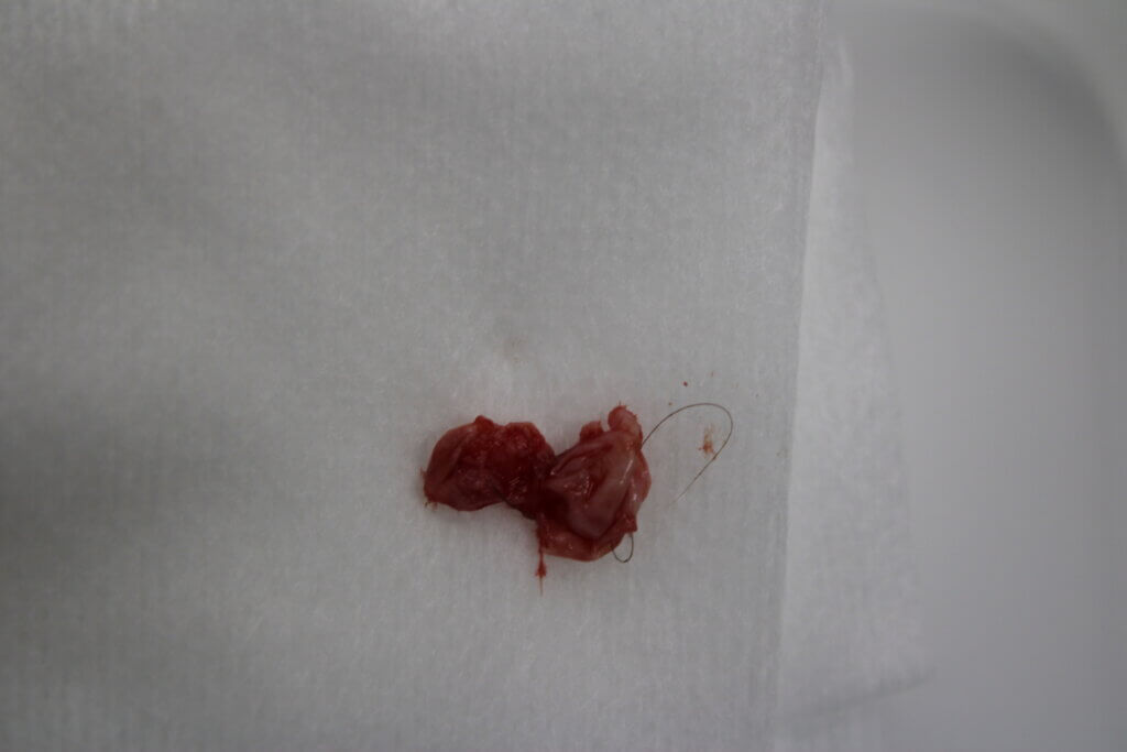 頭の粉瘤をくりぬき法で切除した症例です