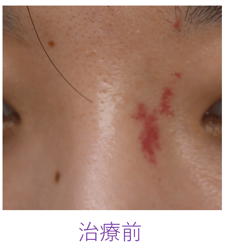 単純性血管腫の治療前の写真
