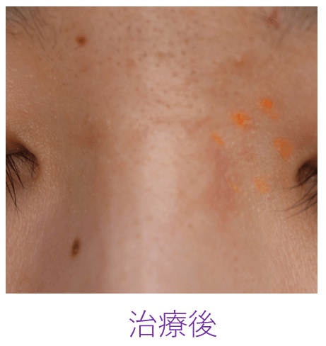 単純性血管腫の治療後の写真