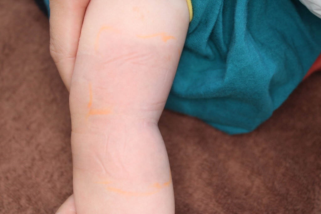 異所性蒙古斑レーザー治療後の写真です