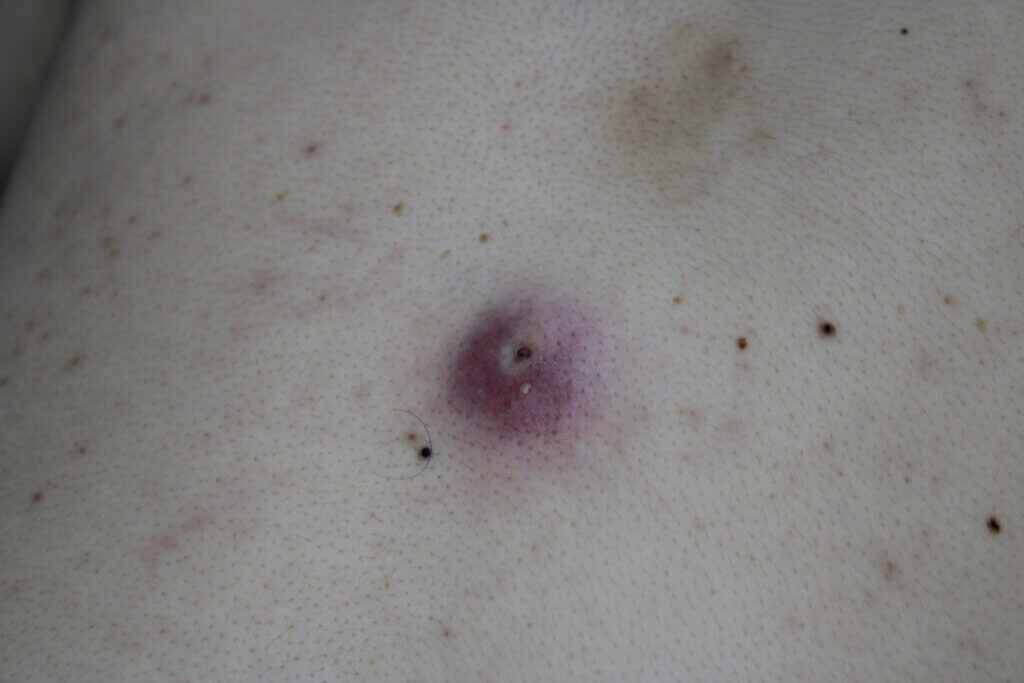 粉瘤に感染を起こしている状態です