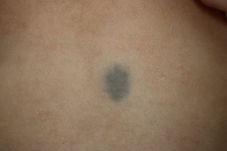 青あざの中でも、異所性蒙古斑