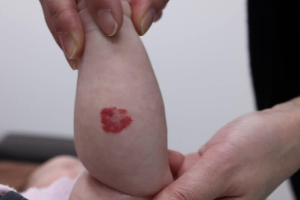 赤あざの中でも、いちご状血管腫の写真