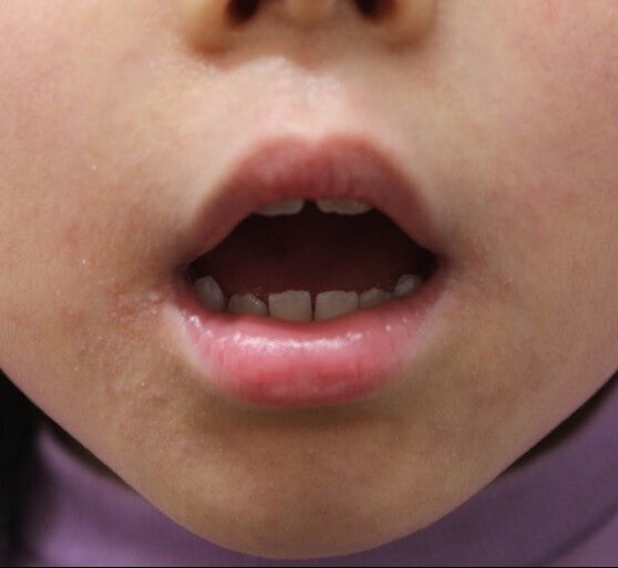 口周りのかゆみ　治療前