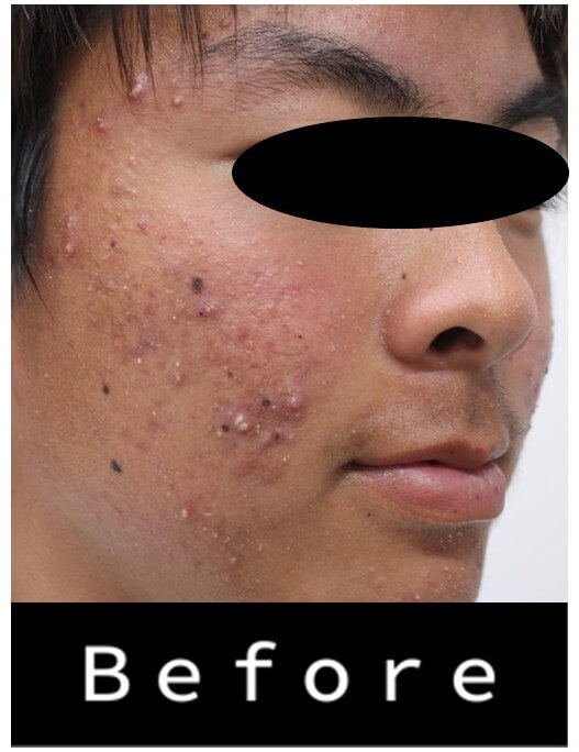 ニキビの保険治療の症例1のbefore画像