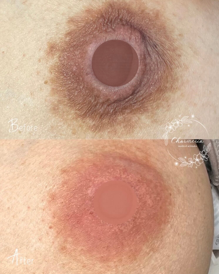 乳頭,乳輪の黒ずみ、色素沈着の症例1