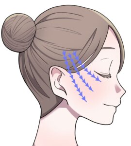 糸リフト(スレッドリフト)の図