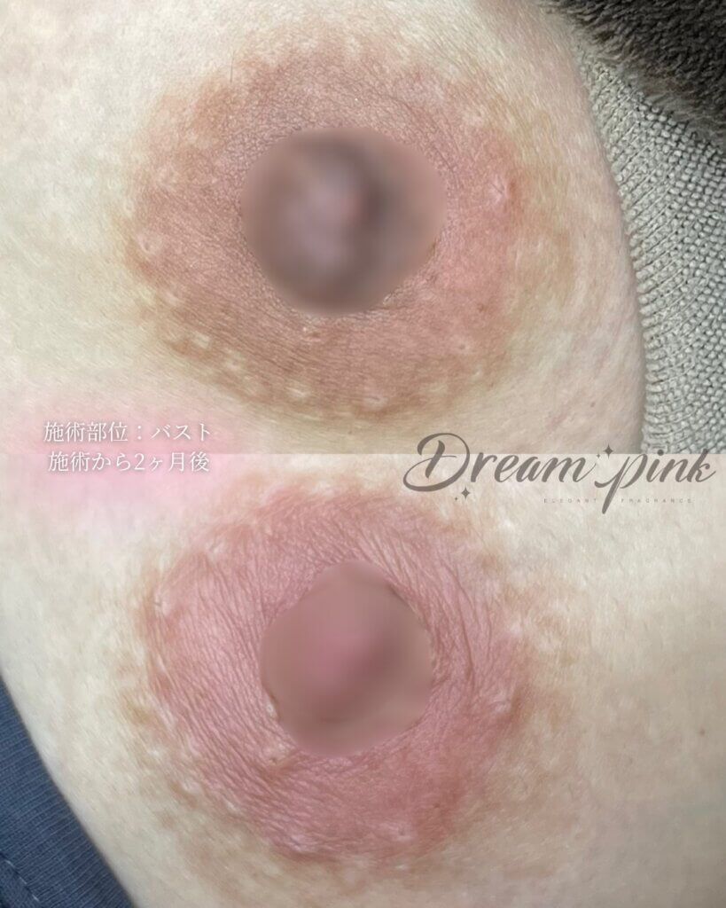 乳輪、乳頭の黒ずみ、色素沈着。治療例