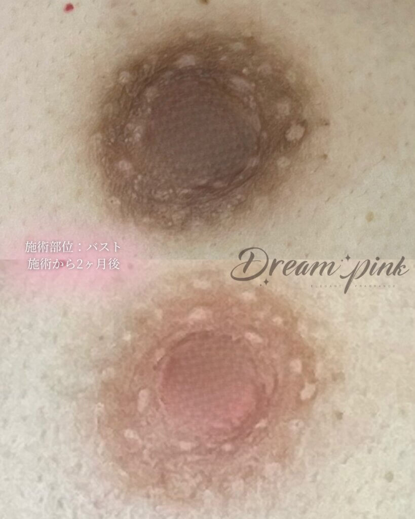 乳輪、乳頭の黒ずみ、色素沈着の治療例