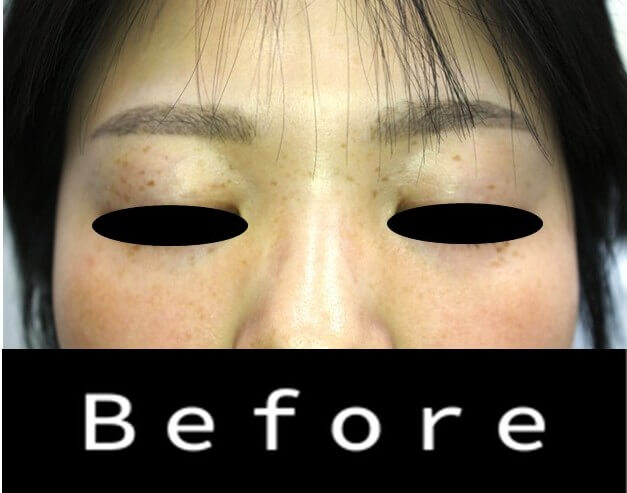 目周りのシミ取り。治療前
